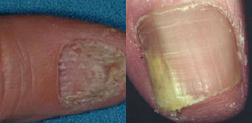 fusarium disease- nail